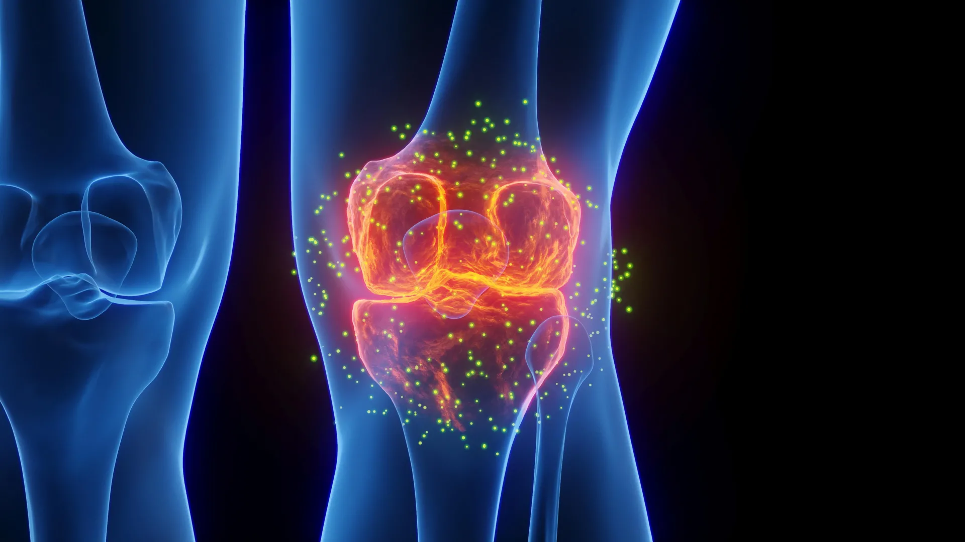 3d knee joint inflammation osteoarthritis